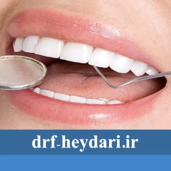 لمینت دندان