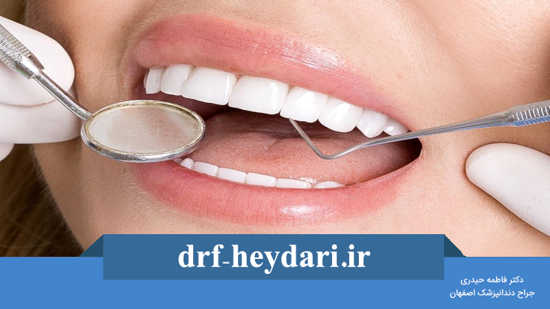 لمینت دندان