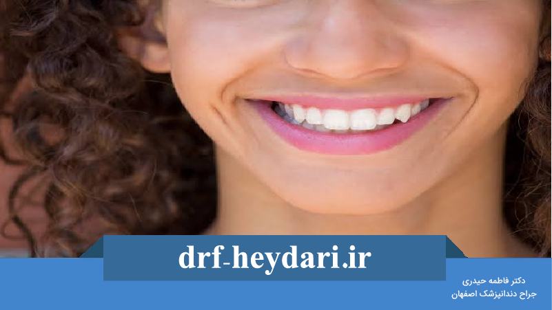 اصلاح طرح لبخند