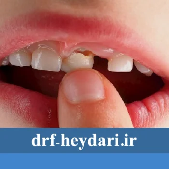 دندان لق شده