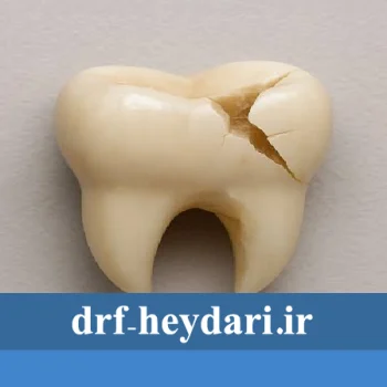 شکستگی دندان و اقدامات فوری