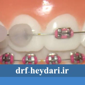 موم ارتودنسی چیست