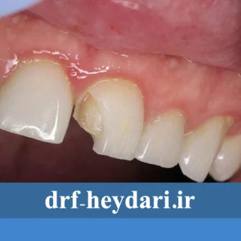 شکستگی لمینیت یا ونیر