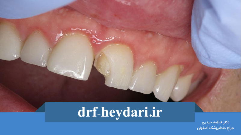 شکستگی لمینیت یا ونیر